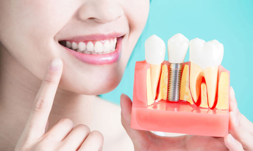 Dental Implants