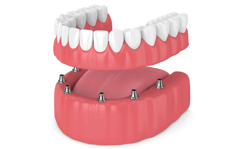 Implant-Retained Dentures