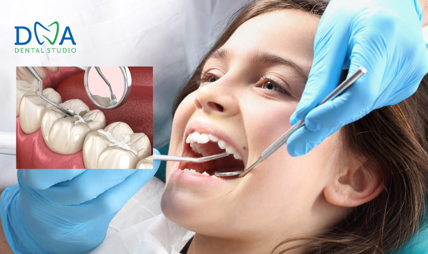 Dental sealants protects the teeth