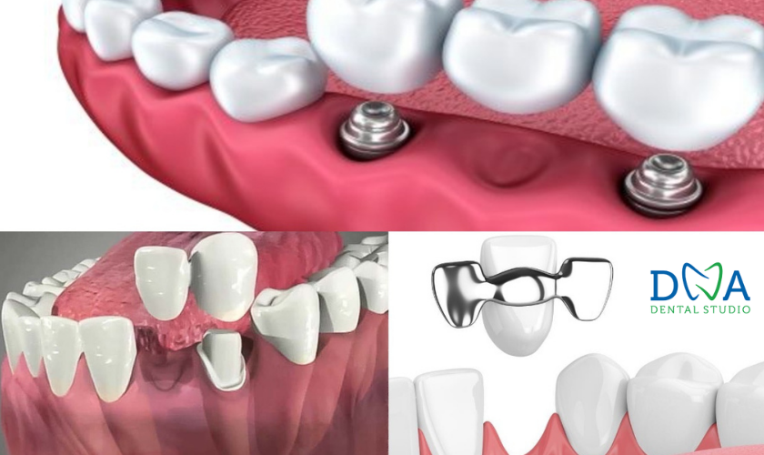 various types of dental bridges