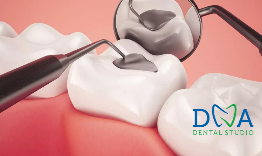 All about Dental Sealants