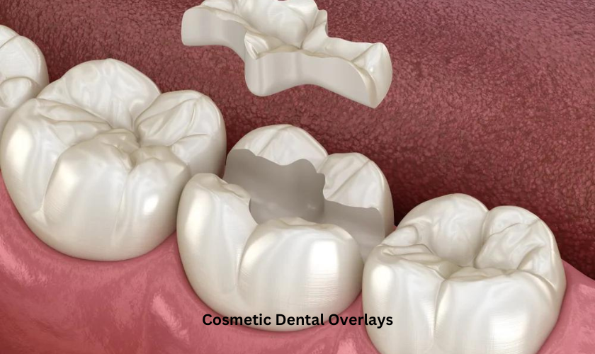 Cosmetic Dental Overlays