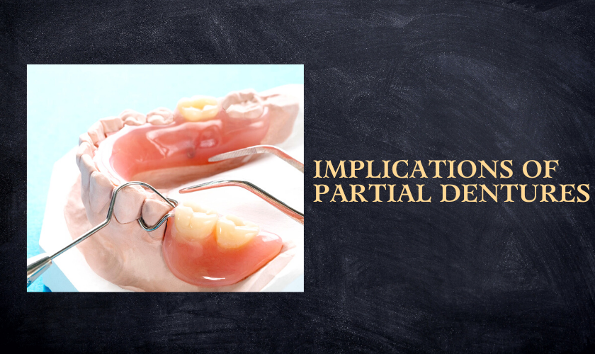 Implications of Partial Dentures
