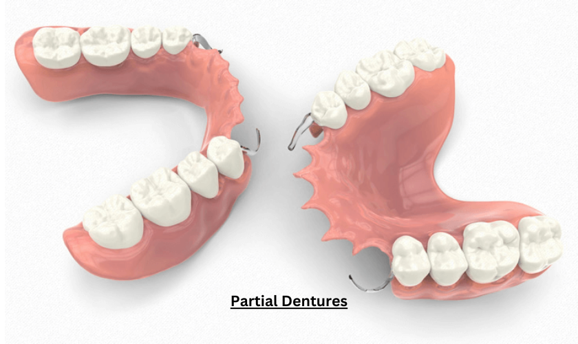 Partial Dentures