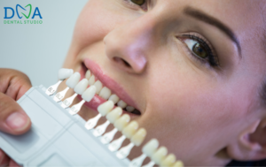 Porcelain Veneers in Burbank