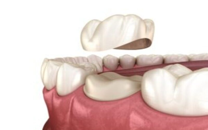 Dental Crowns - DNA Dental Studio Burbank, CA