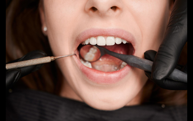 Fillings Restoration - DNA Dental Studio - Burbank, CA