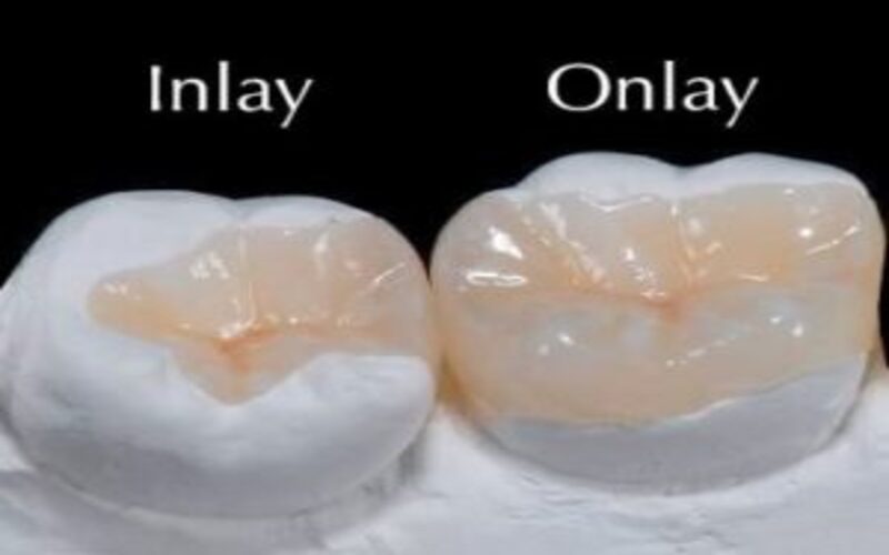 Inlays And Onlays - DNA Dental Studio Burbank, CA