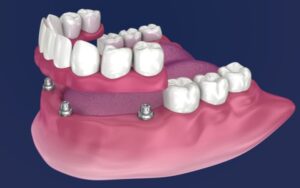 Implant Retained Dentures - DNA Dental Studio, Burbank, CA
