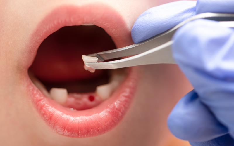 Tooth Extraction - DNA Dental Studio, Burbank,CA