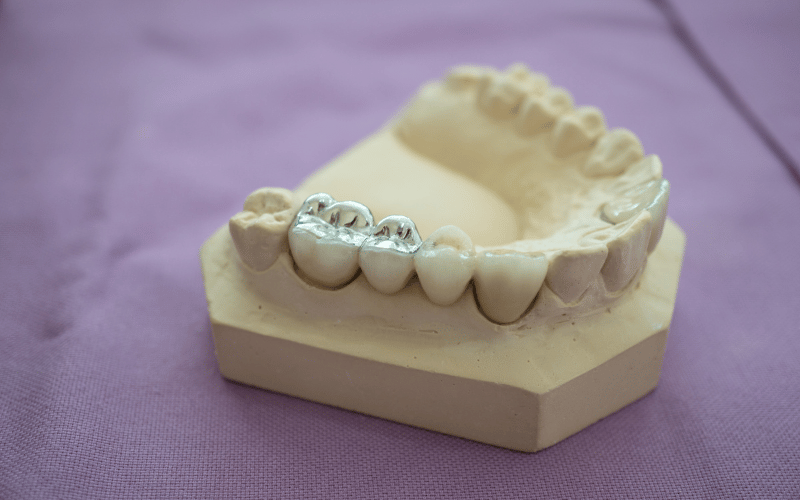 different types of dental fillings