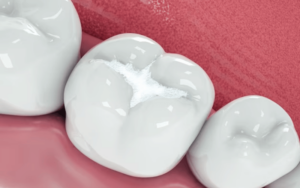 are white fillings better for teeth