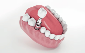 can dental implants be completed in one day