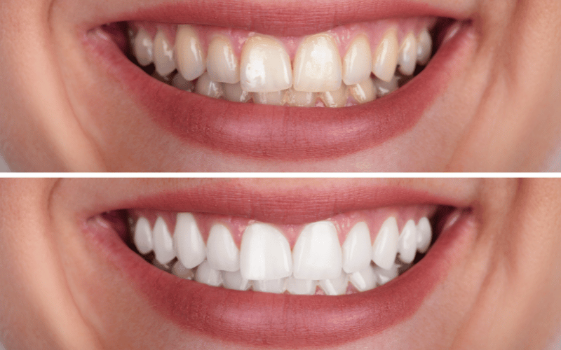 Side Effects of Teeth Whitening