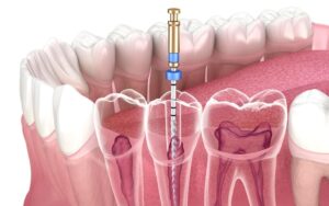 Do Root Canals Cause Cancer