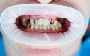 What Are the Symptoms Of Poor Oral Health?