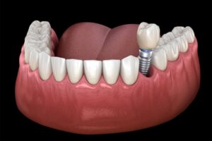 The Connection Between Dental Implants and Jawbone Health