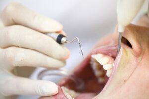 How Often Do You Really Need Periodontal Maintenance