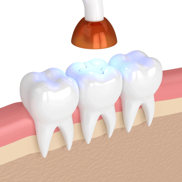 Tooth Fillings in Glendale, CA at DNA Dental Studio