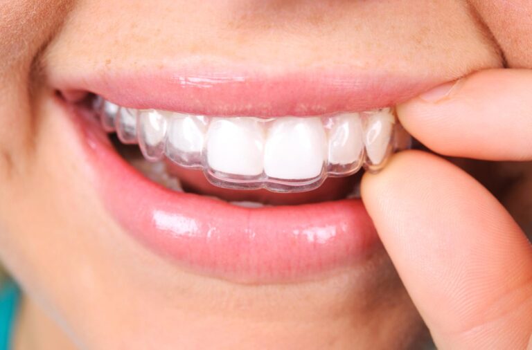 Invisalign at DNA Dental Studio in Glendale, CA