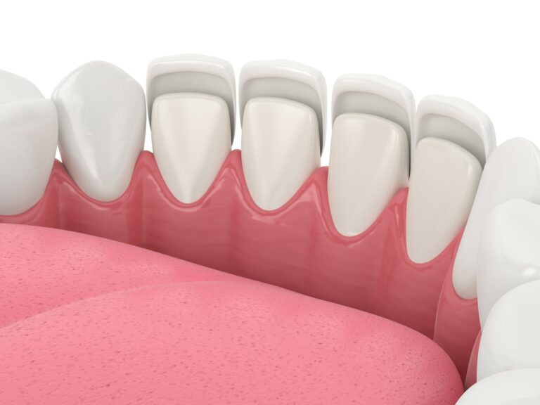 Dental veneers at DNA Dental Studio in Glendale, CA