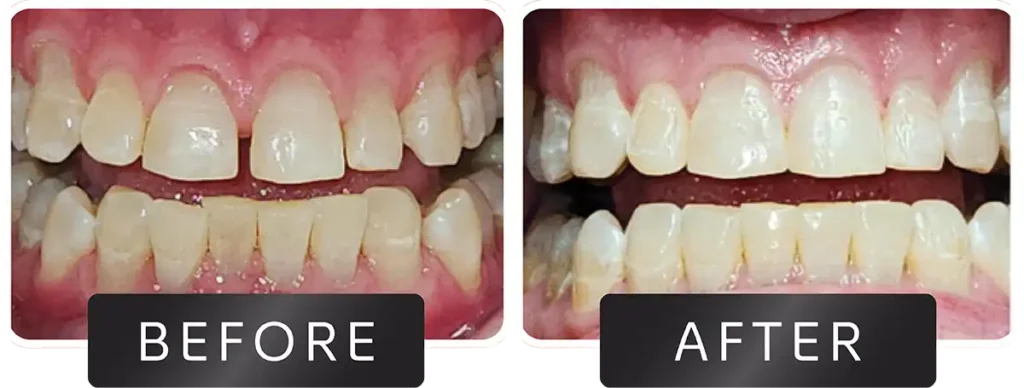 Smile transformation before and after cosmetic dental procedure at DNA Dental Studio Glendale CA