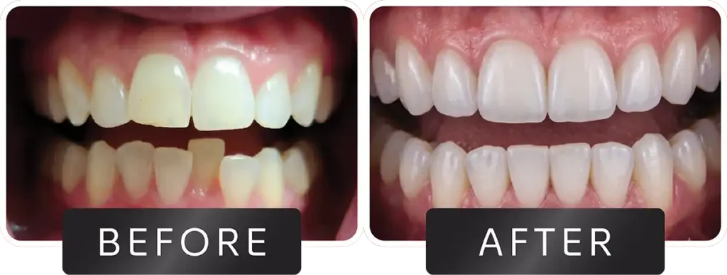 Smile transformation before and after teeth whitening and cosmetic dental procedure at DNA Dental Studio Glendale CA