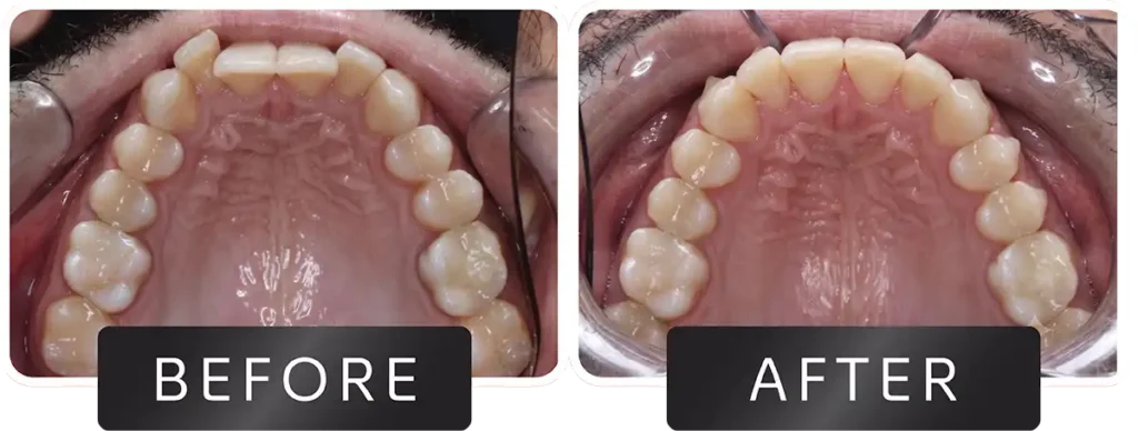 Smile transformation before and after dental procedure at DNA Dental Studio Glendale CA