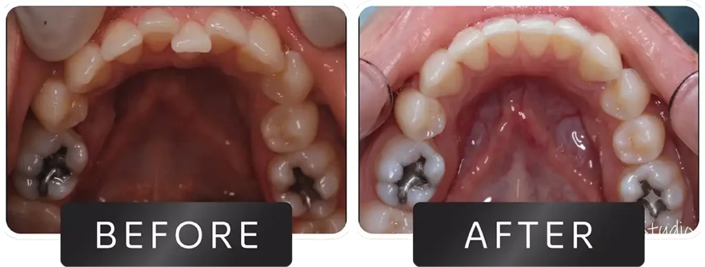 Smile transformation before and after dental procedure at DNA Dental Studio Glendale CA
