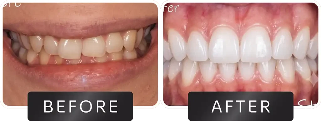 Smile transformation before and after dental procedure at DNA Dental Studio Glendale CA