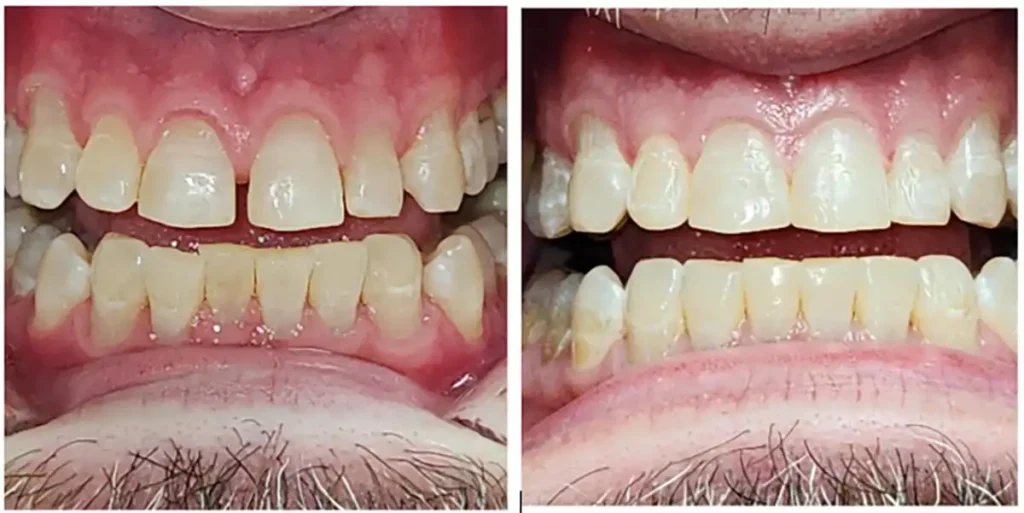 Dental Patient Alan - before & after Invisalign Results at DNA Dental Studio in Glendale, CA