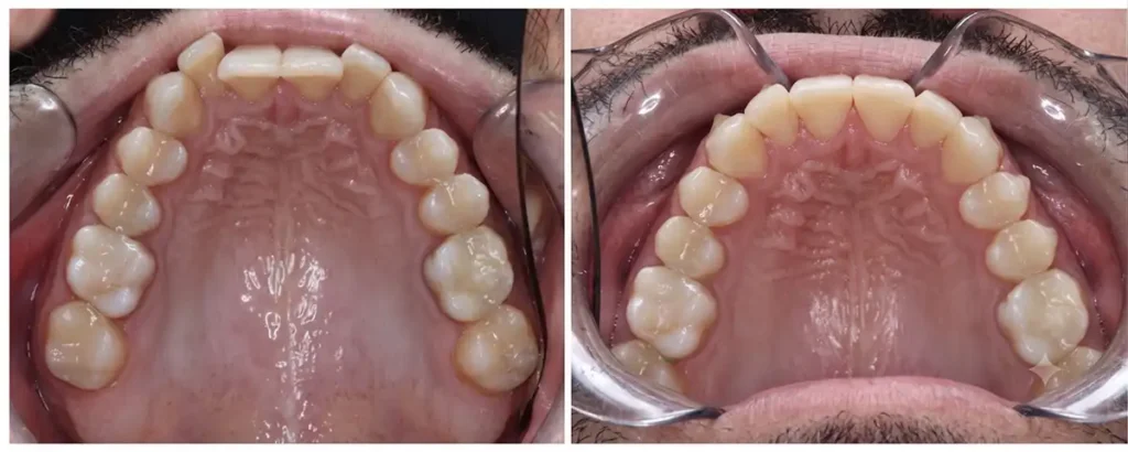 Dental Patient Koko - before & after Invisalign Results at DNA Dental Studio in Glendale, CA