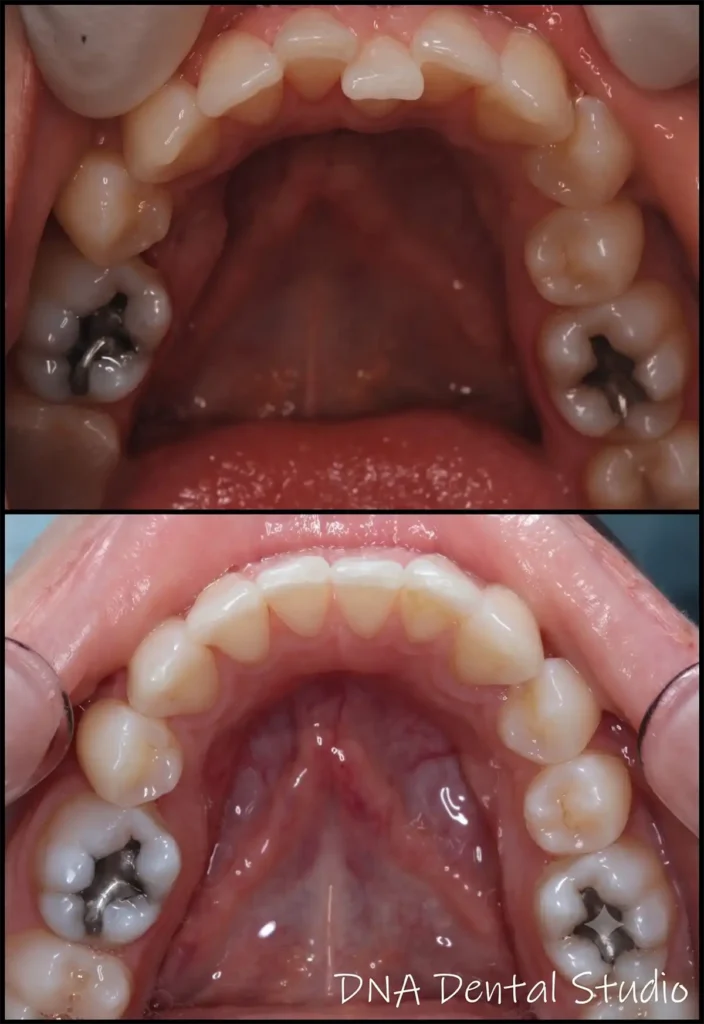Dental Patient Lower before & after Invisalign Results at DNA Dental Studio in Glendale, CA