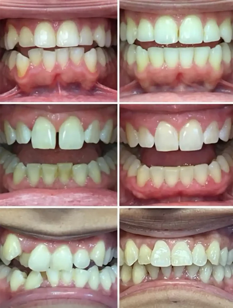 Invisalign Results at DNA Dental Studio in Glendale, CA