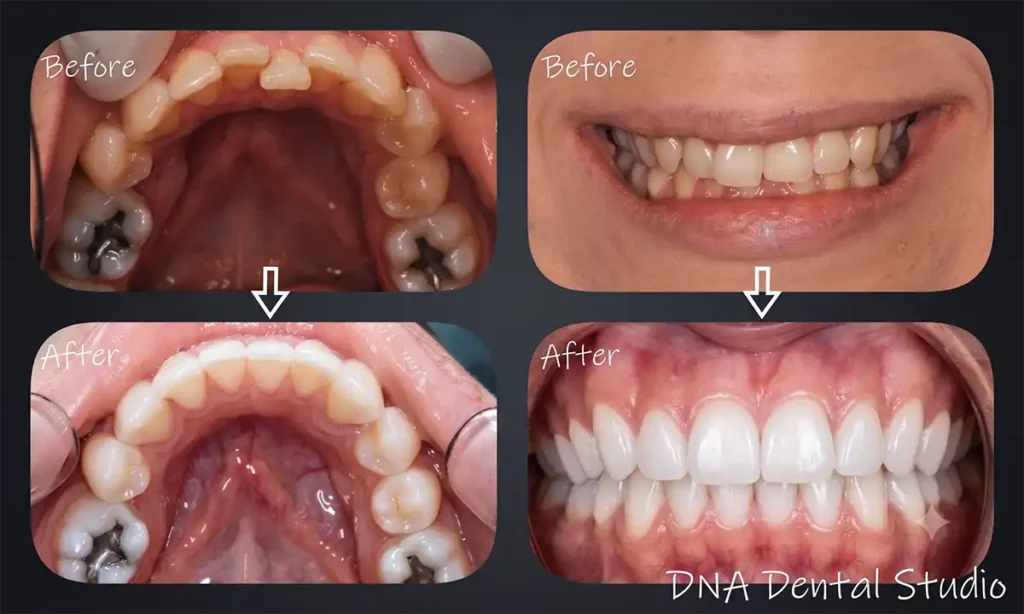 Dental Patient Suzy after photos Invisalign Results at DNA Dental Studio in Glendale, CA