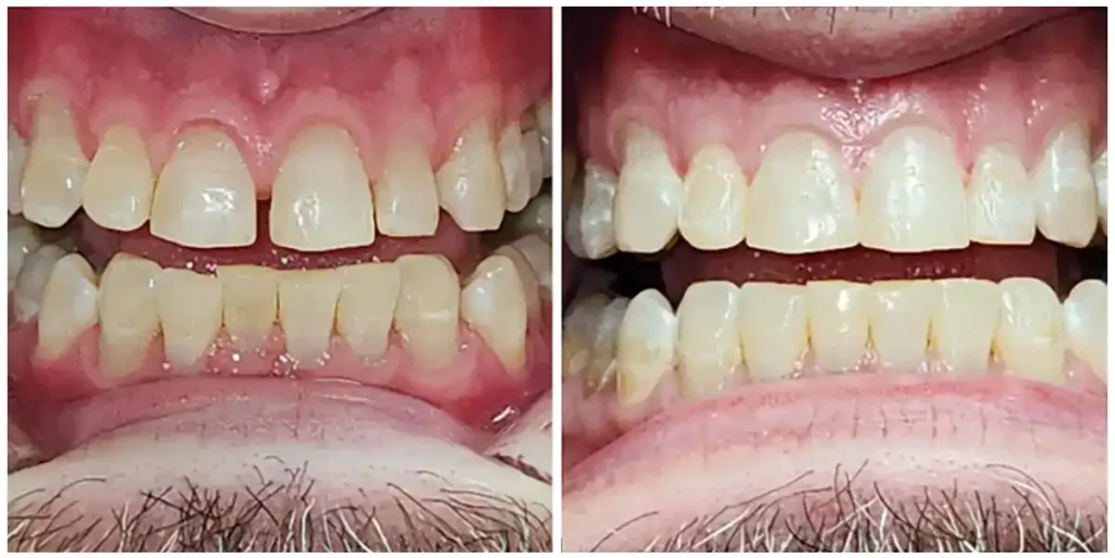 Before & After Invisalign Results at DNA Dental Studio in Glendale, CA