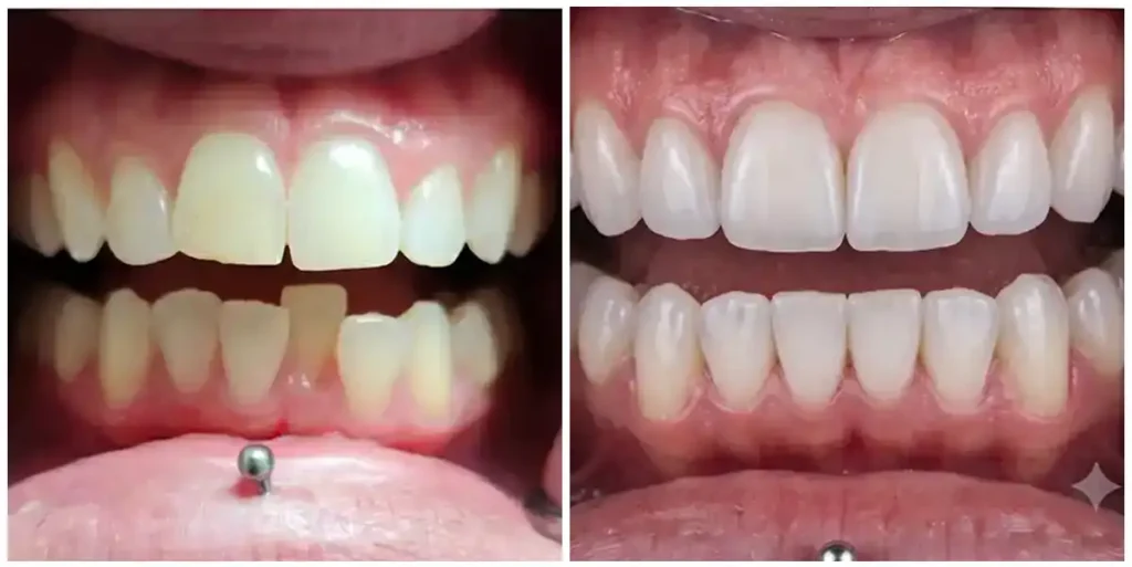 Before & After Invisalign Results at DNA Dental Studio in Glendale, CA
