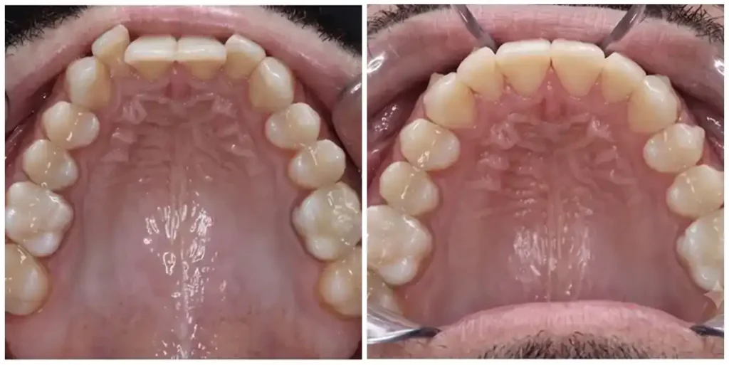 Before & After Invisalign Results at DNA Dental Studio in Glendale, CA