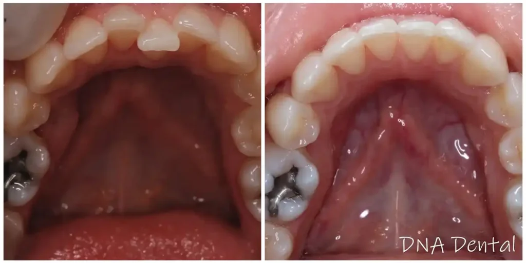Before & After Invisalign Results at DNA Dental Studio in Glendale, CA