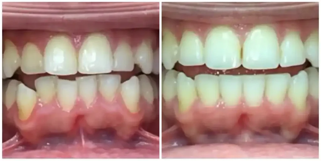 Before & After Invisalign Results at DNA Dental Studio in Glendale, CA