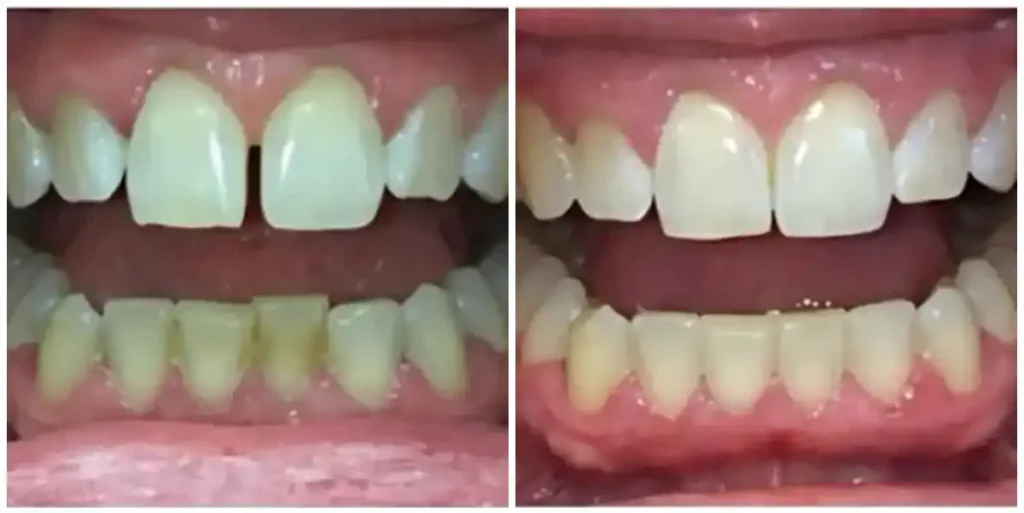 Before & After Invisalign Results at DNA Dental Studio in Glendale, CA