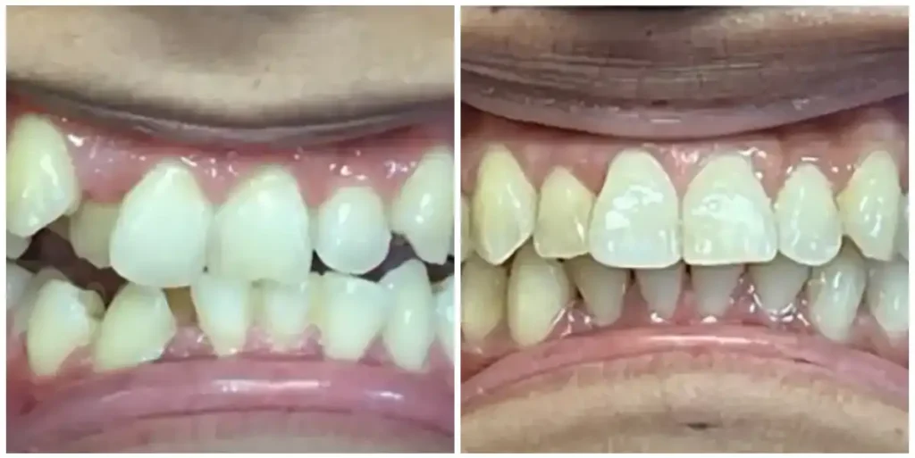 Before & After Invisalign Results at DNA Dental Studio in Glendale, CA